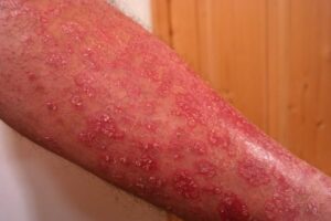 schuppenflechte psoriasis