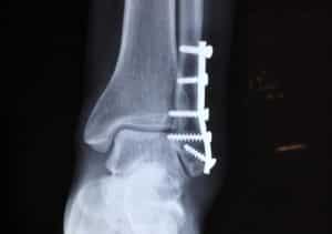 vitamin k2 mangel