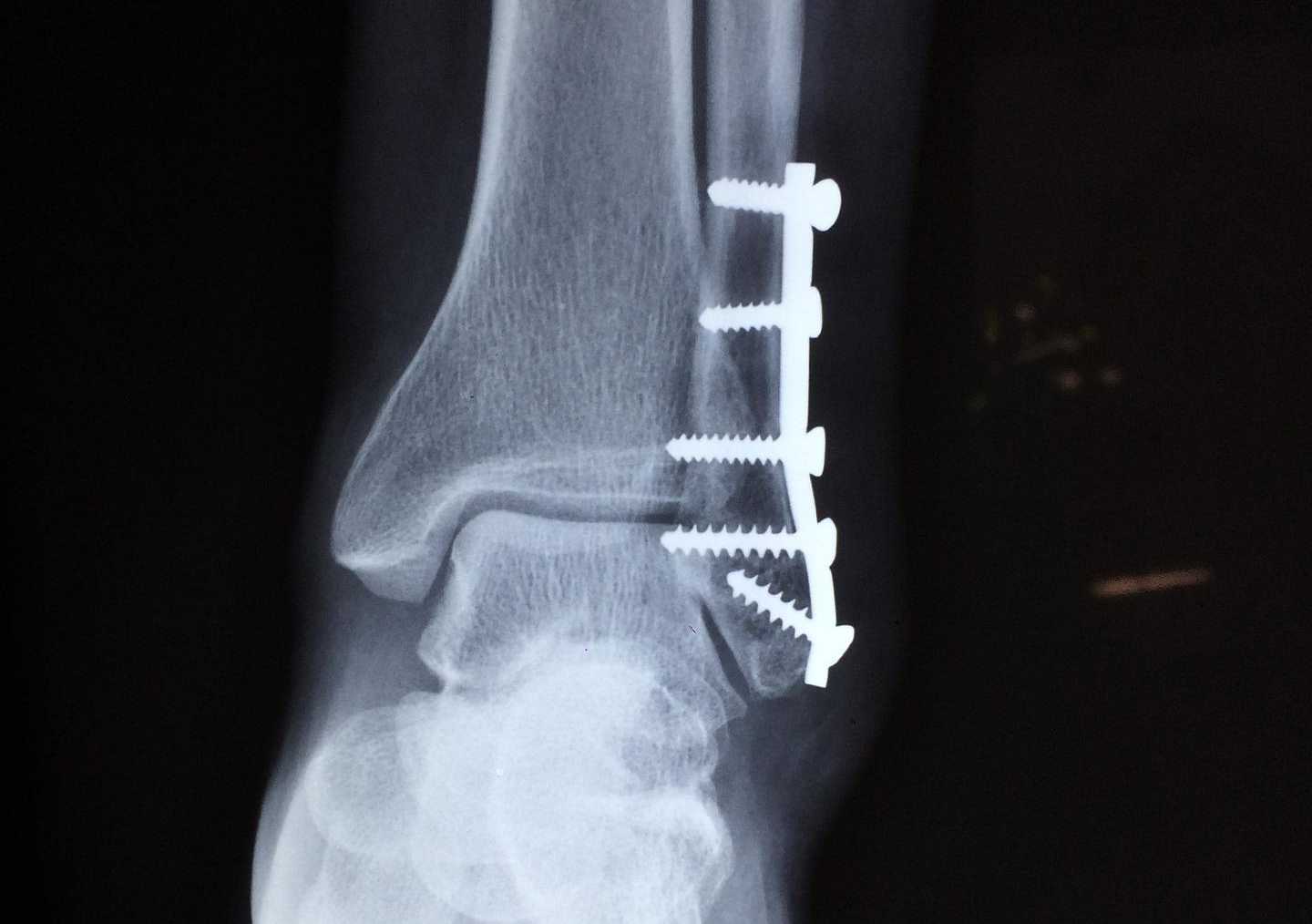 vitamin k2 mangel